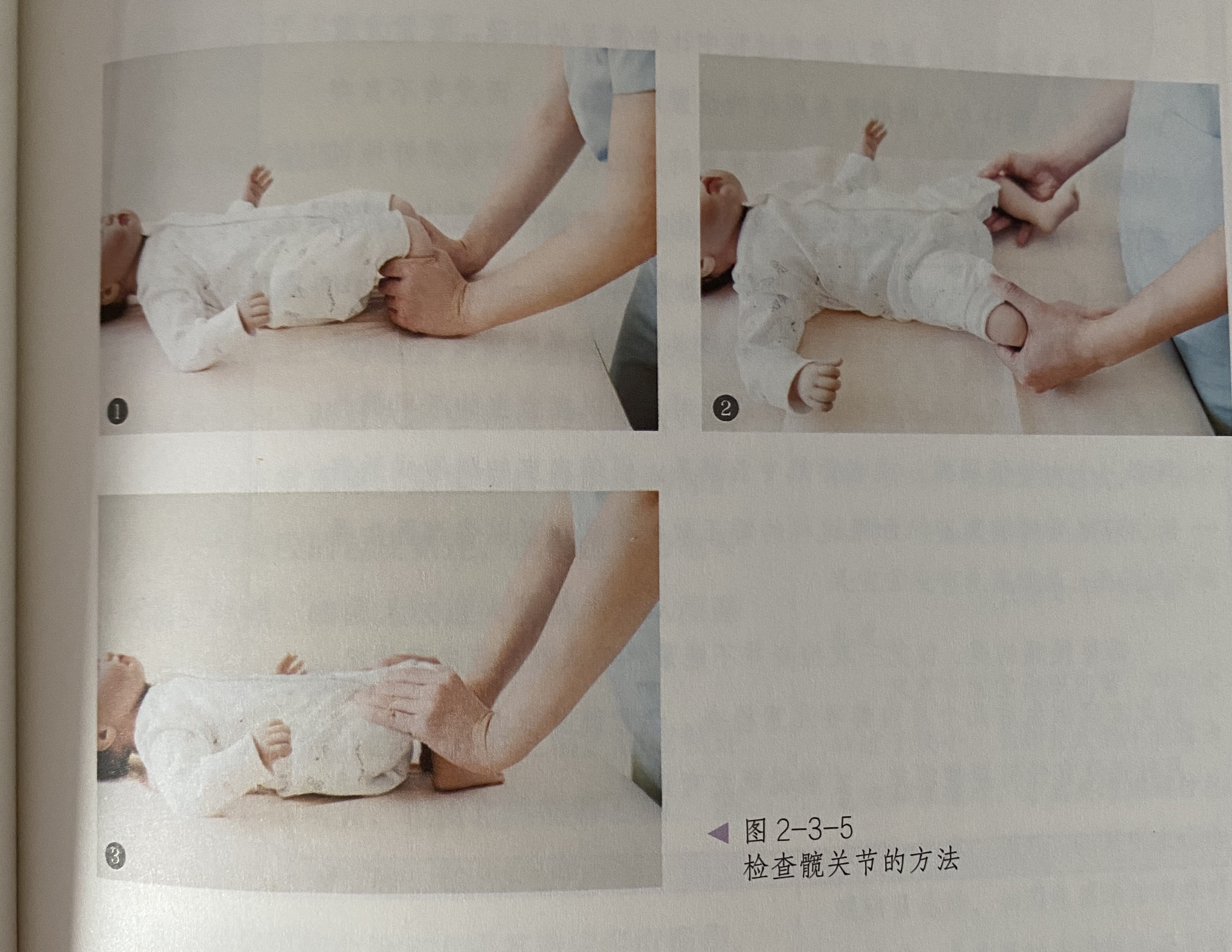 新生儿髋关节发育不良自测 1.