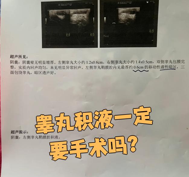 先天性睾丸鞘膜积液是孩子出生时就有的,通常是交通性的