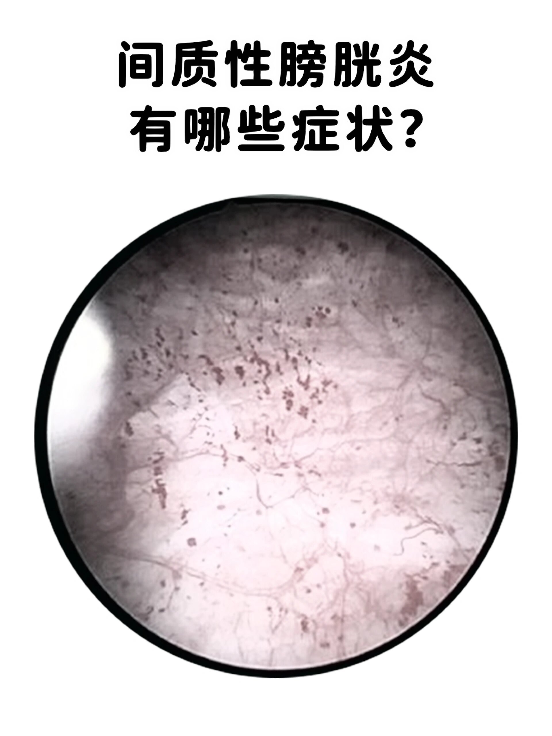 间质性膀胱炎有哪些症状?