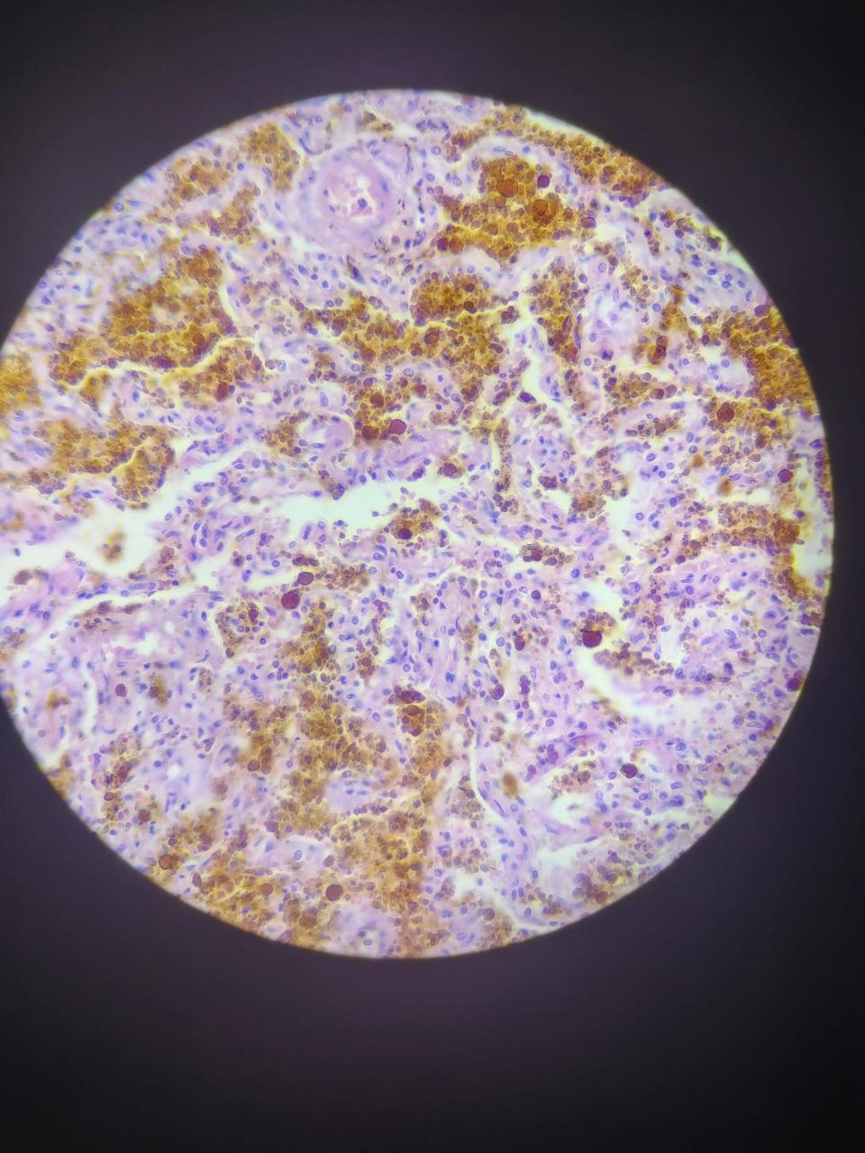 慢性肺淤血 慢性肺淤血 4*0.1 10*0.25 10*40