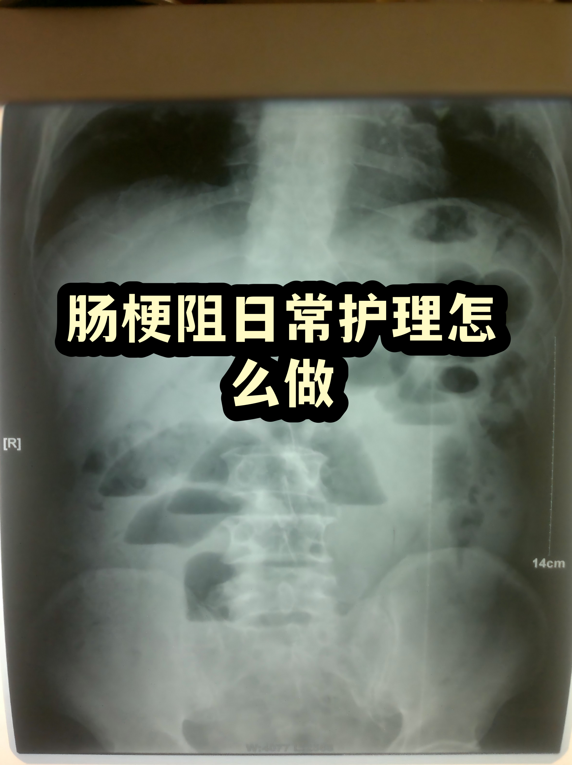 302医院陪诊代挂号出院居家护理提醒，科学恢复身体的简单介绍