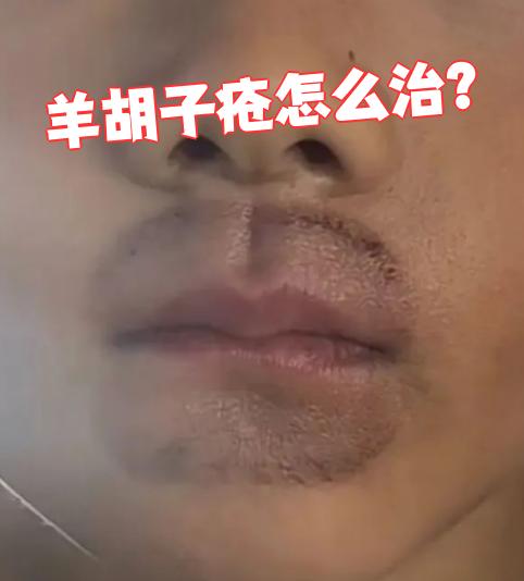 治疗羊胡子疮(须疮)主要分三步走: