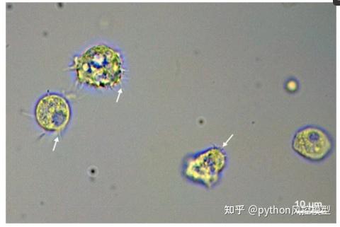 棘阿米巴acastellanii角膜炎警惕眼睛失明