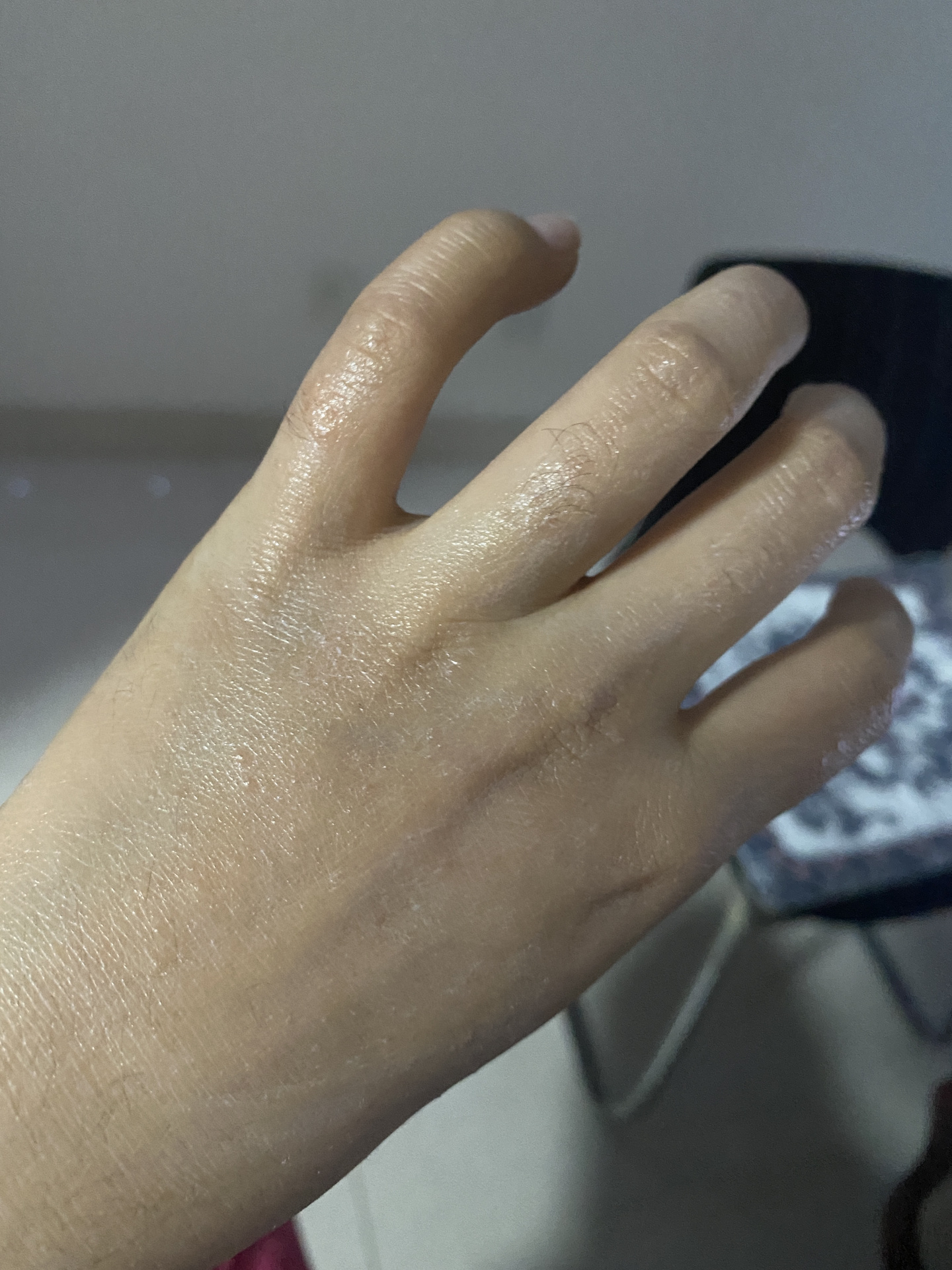 手又又又过敏了  图26615的过敏怎么讲:就是戴一次性医用橡胶手套