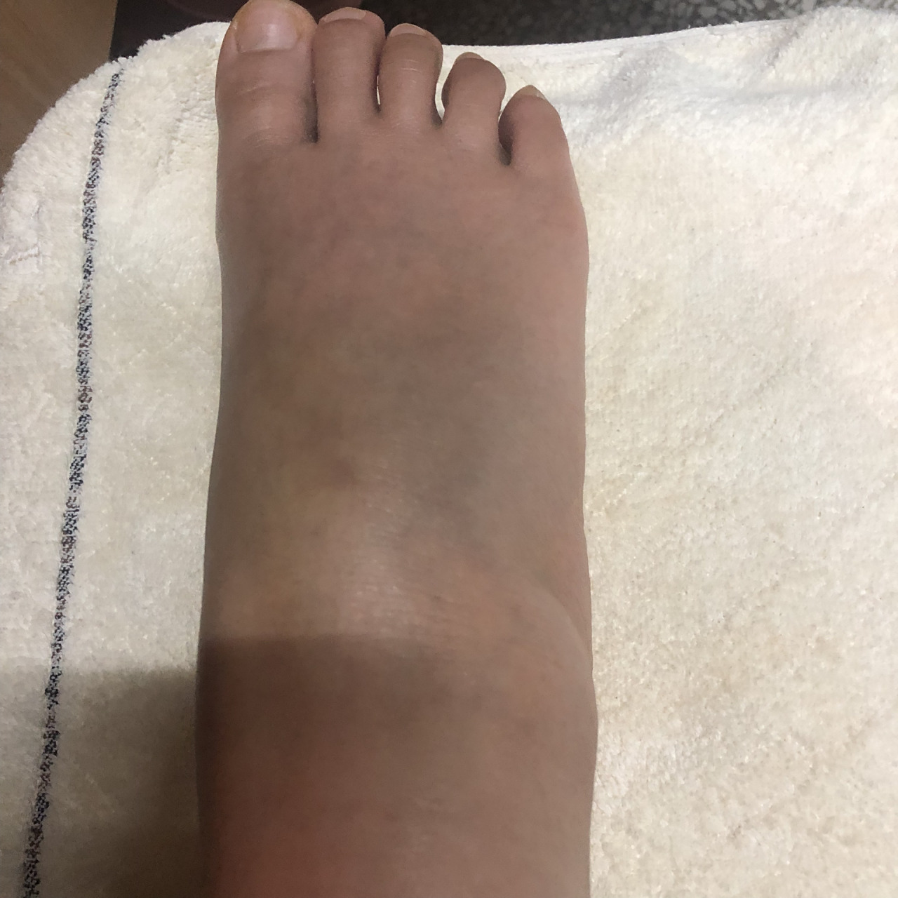 脚背被砸伤的第五天 感觉又稍微肿了一点,但不痛 	 希望一周能恢复