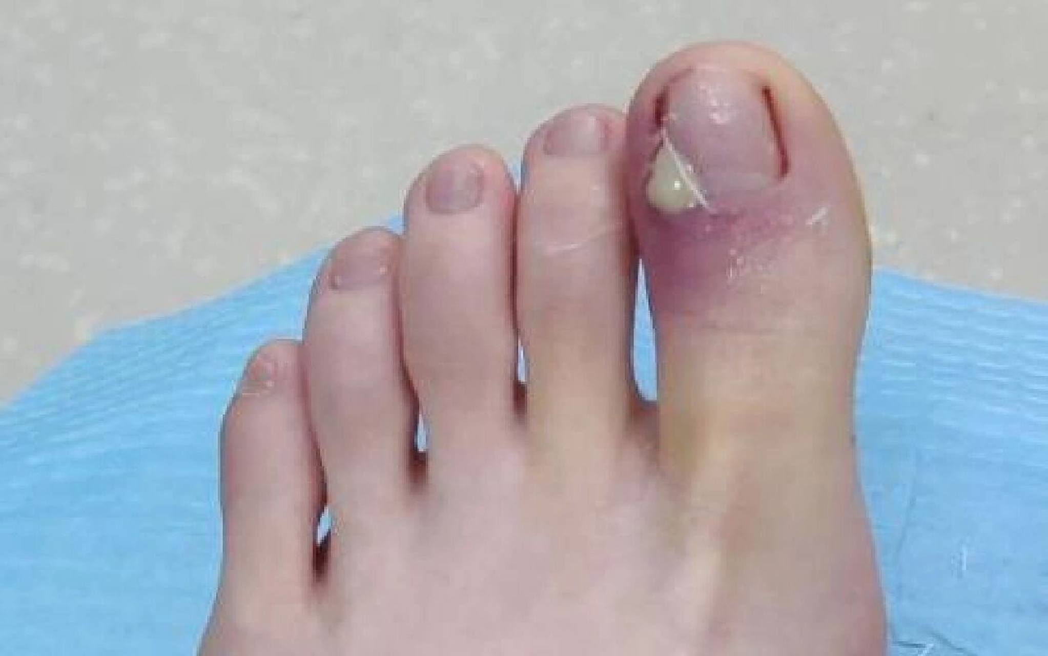 脚指甲红肿化脓怎么处理 走路跑步,运动站立,每个人每天再平常不过的