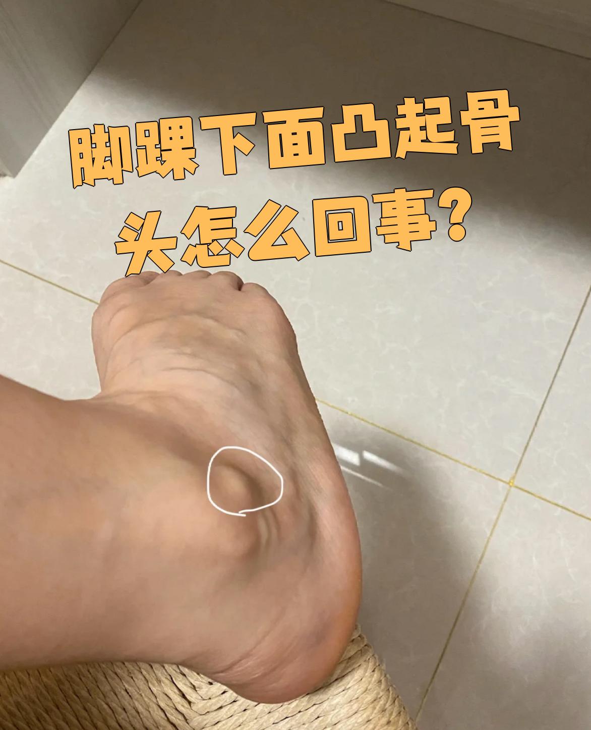 脚踝下方出现骨头凸起是常见现象,可能只是正常结构,也可能是疾病