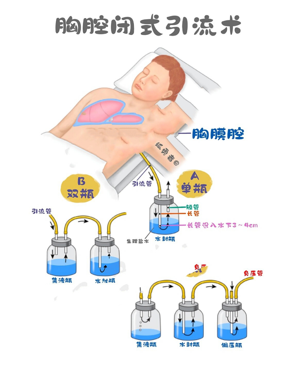 胸腔闭式引流术