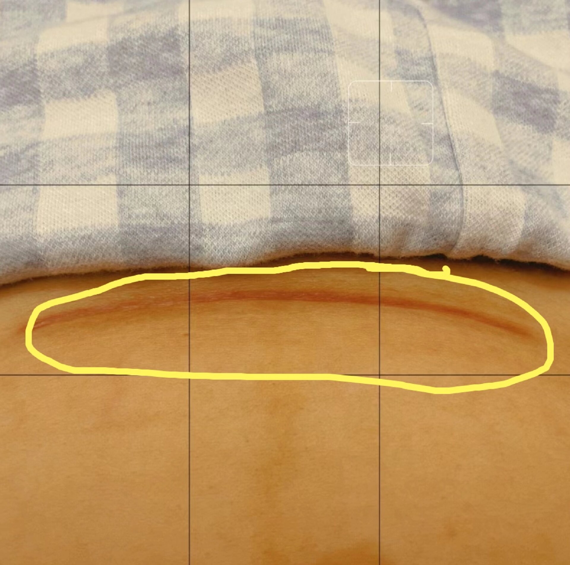 剖腹产两个多月了,红红的这是增生了吗?