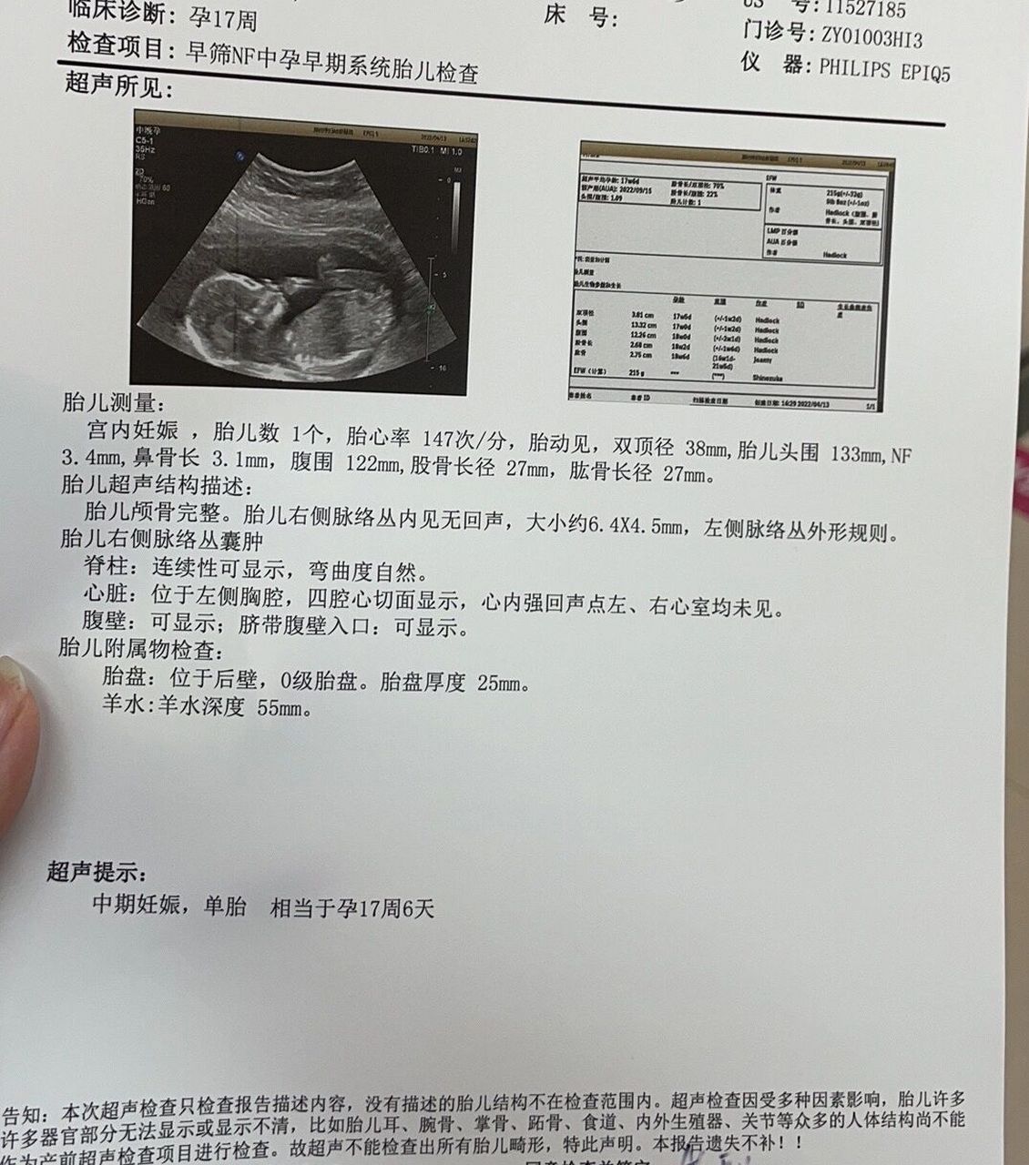 17周nf胎儿右侧脉络丛囊肿 姐妹们01今天去做nf发现宝宝右侧有脉络