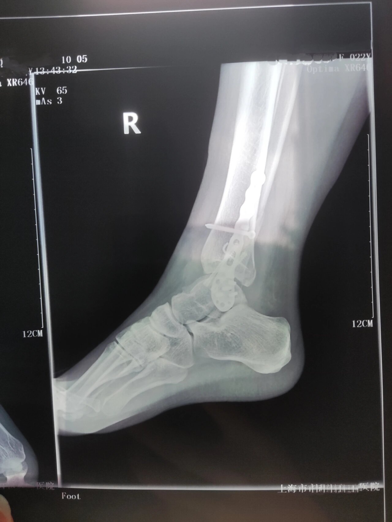 三踝骨折手术后40天