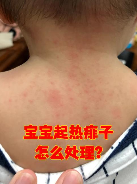 是因为天气热,汗排不出去引起的皮肤问题