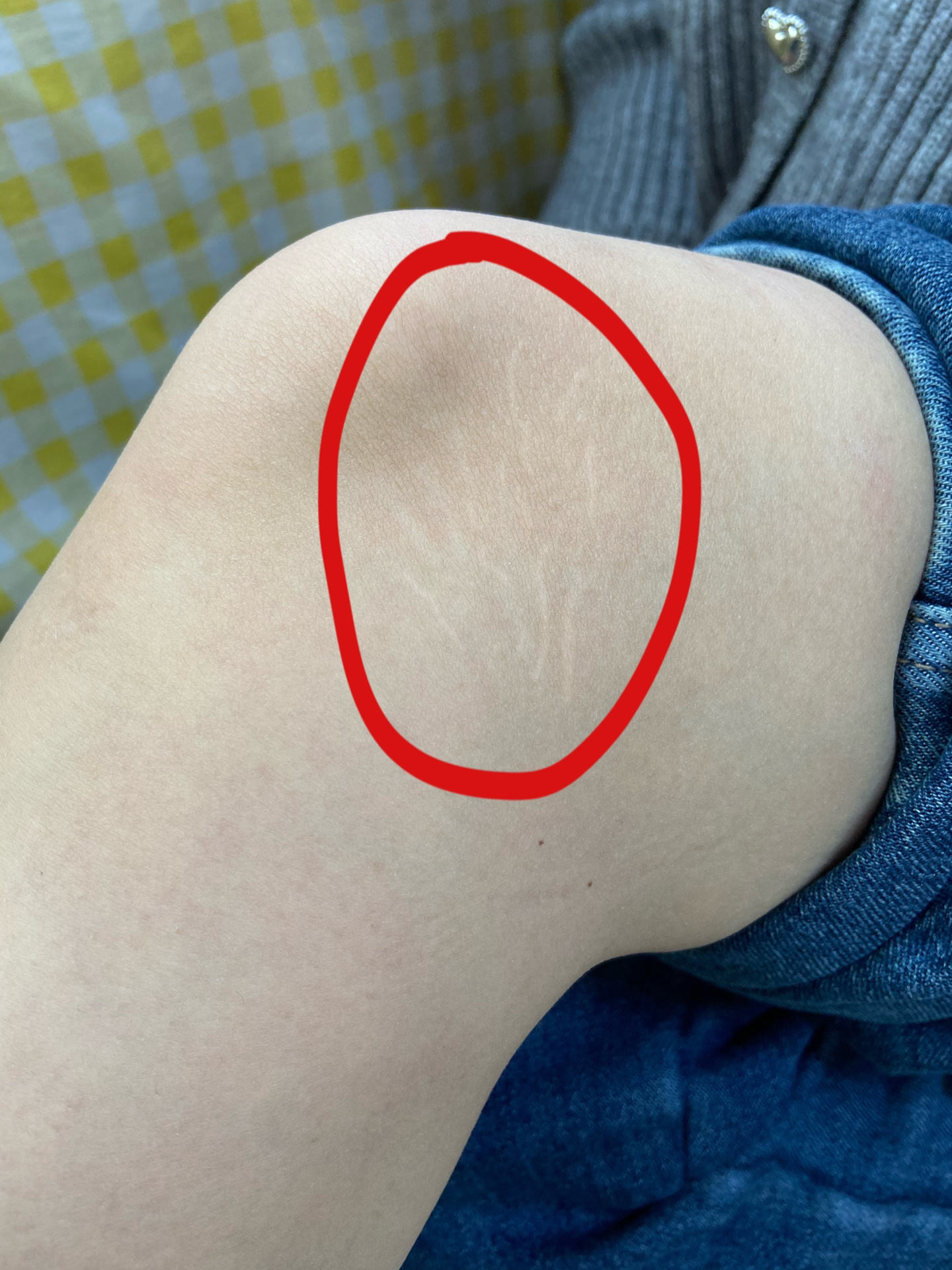 认认真真去肥胖纹的两个月