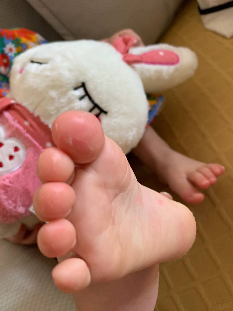 幼儿脚丫脱皮后续, 情况在好转. 尿素乳膏可👌