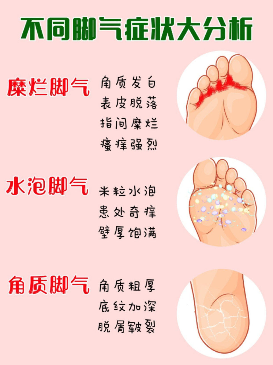 不同脚气症状大分析,你想要的这都有 99哎,一到夏天就满脚的水泡,痒
