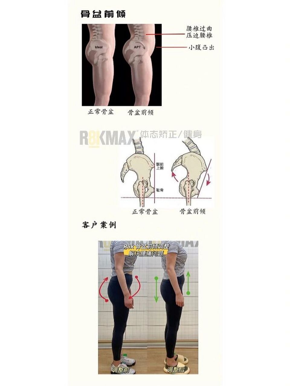 骨盆前倾图片对比图片