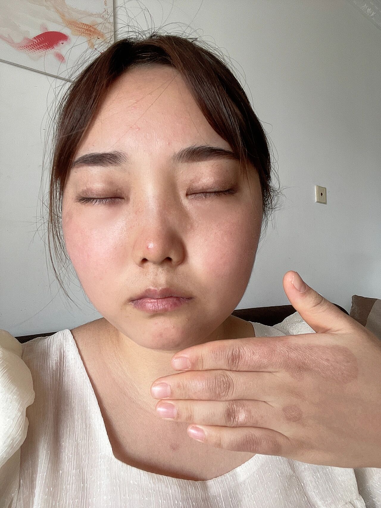 红斑狼疮 满月脸,水牛背,还有印记,医生说是吃药的原