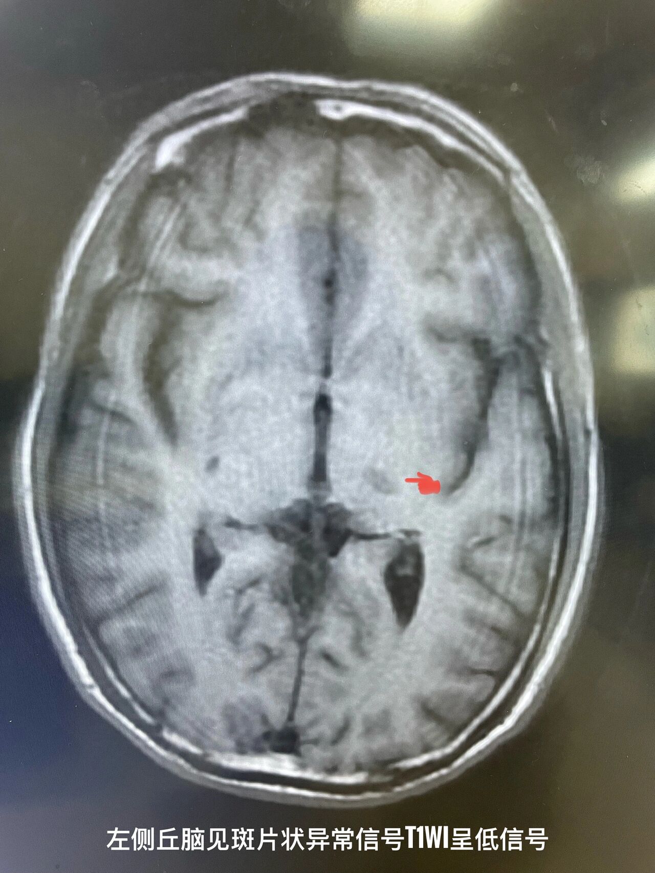 95亚急性脑梗死mri影像学习