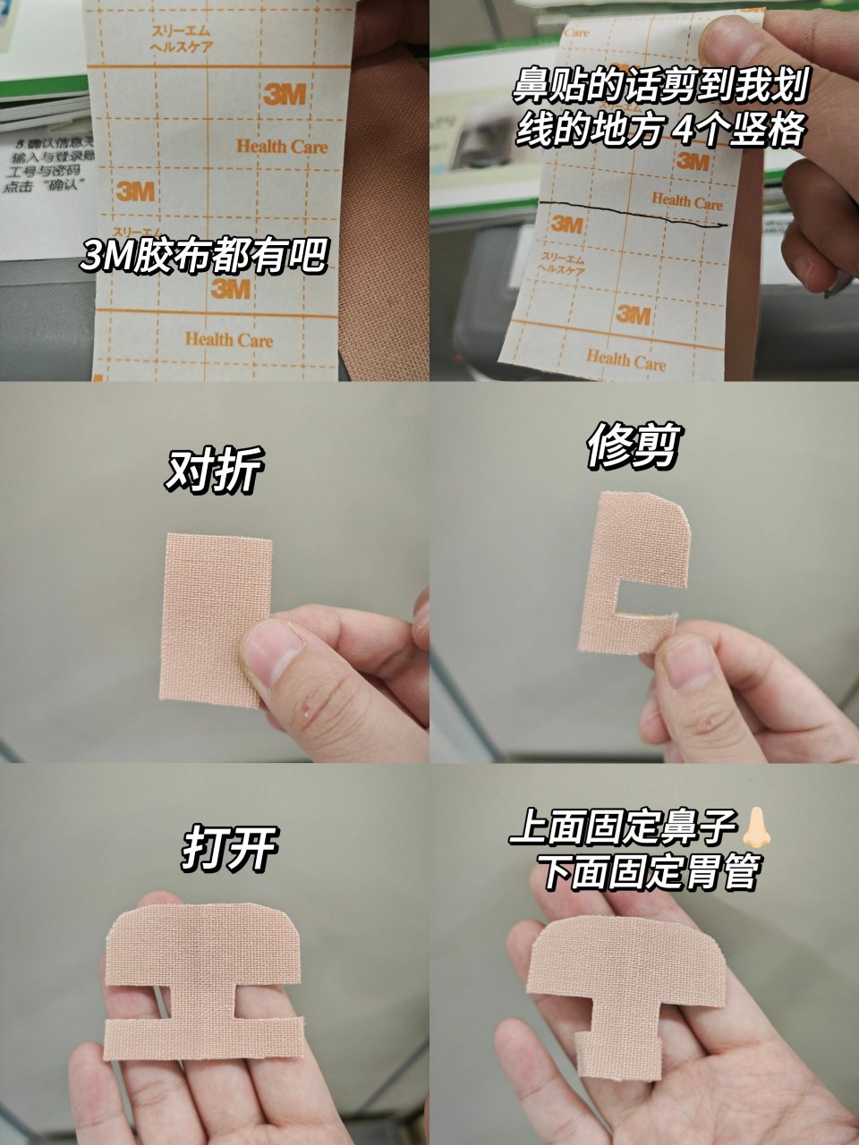 临床胃管的固定方法 鼻肠管 enbd管 从鼻子出来的管子都可以这么固定