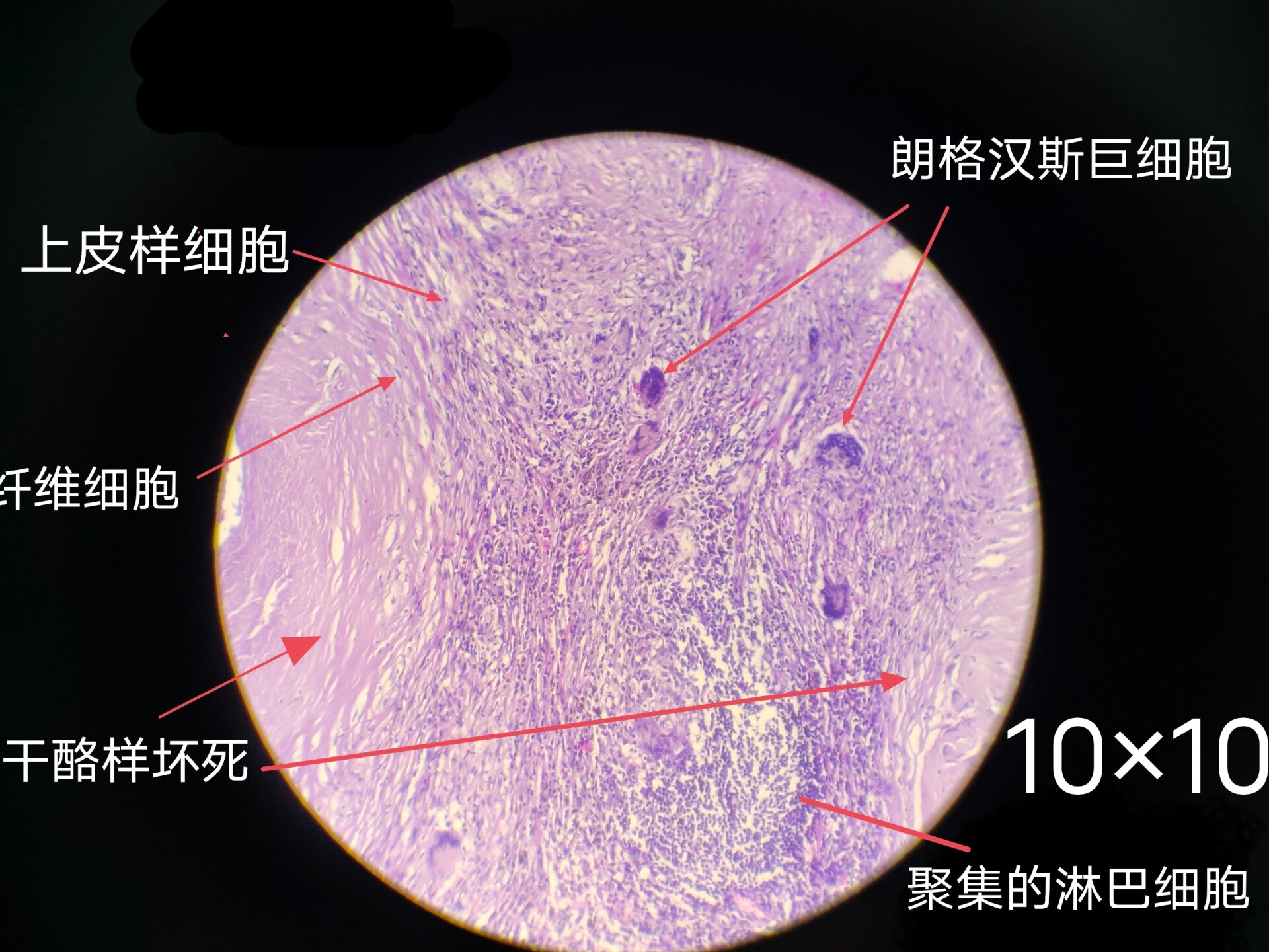 结核干酪样坏死红蓝铅 病理学实验报告