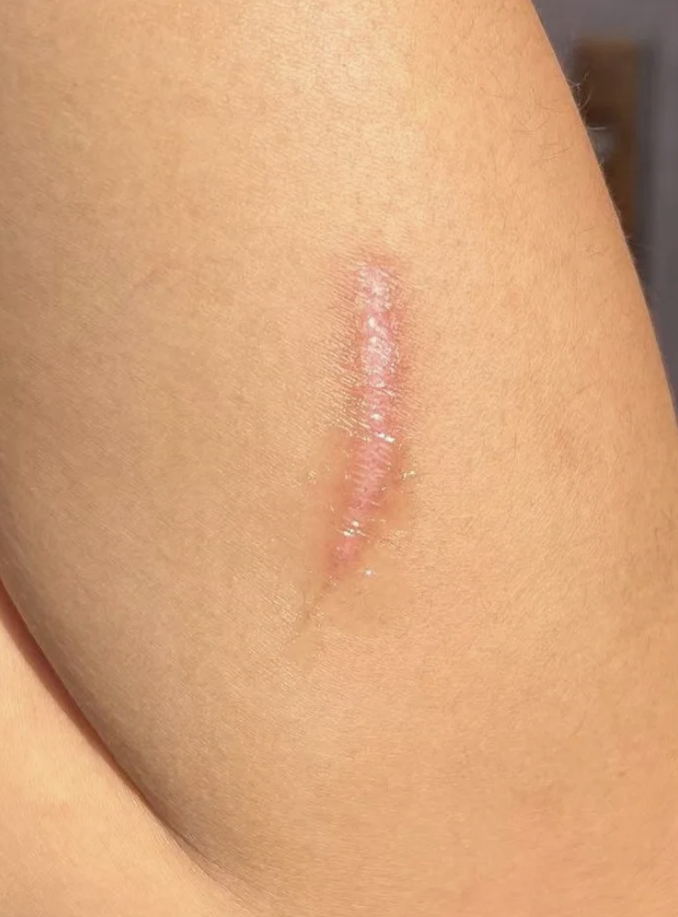 疤痕性皮肤最常见的原因是外伤和遗传因素