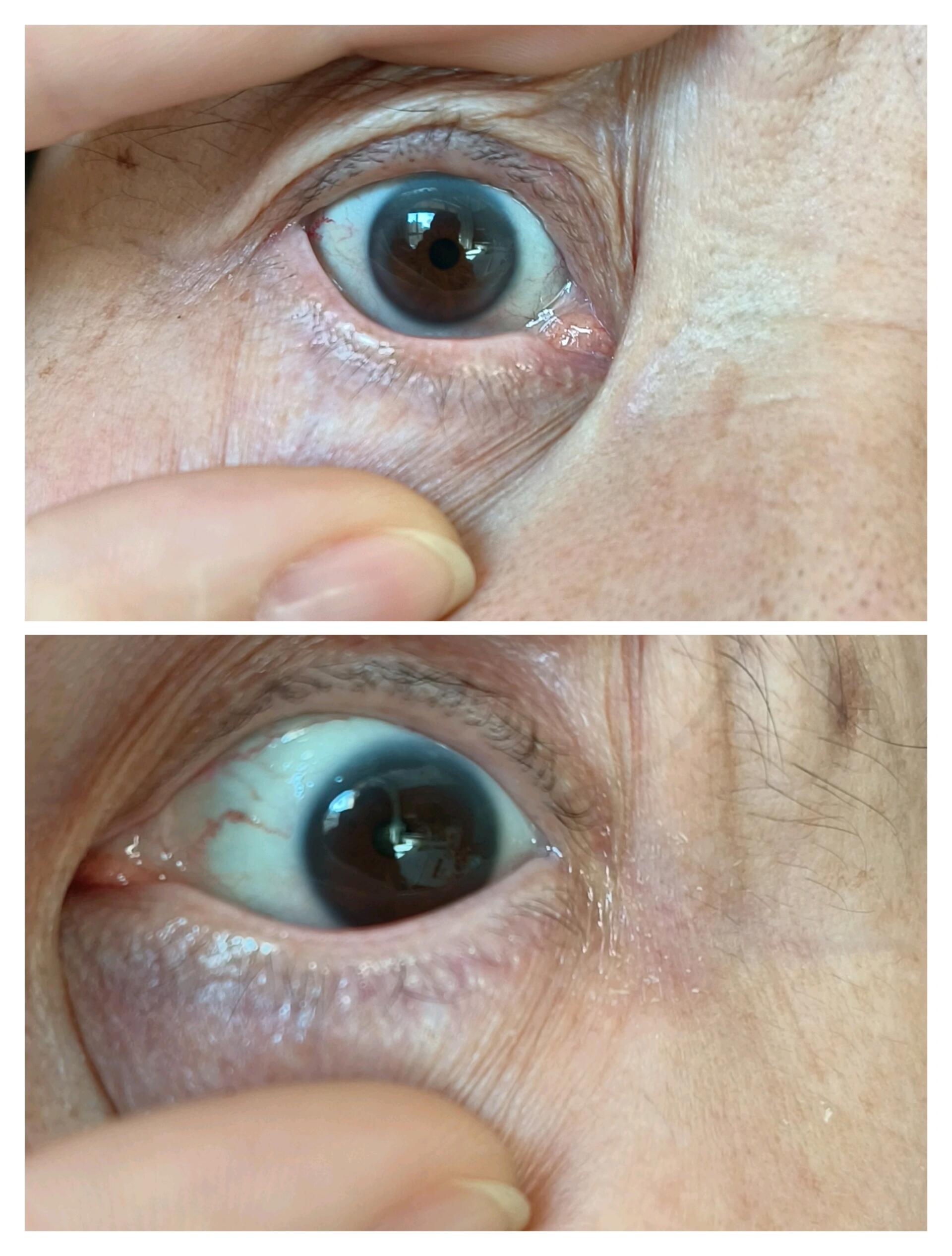 老年环,真实记录,眼睛不舒服