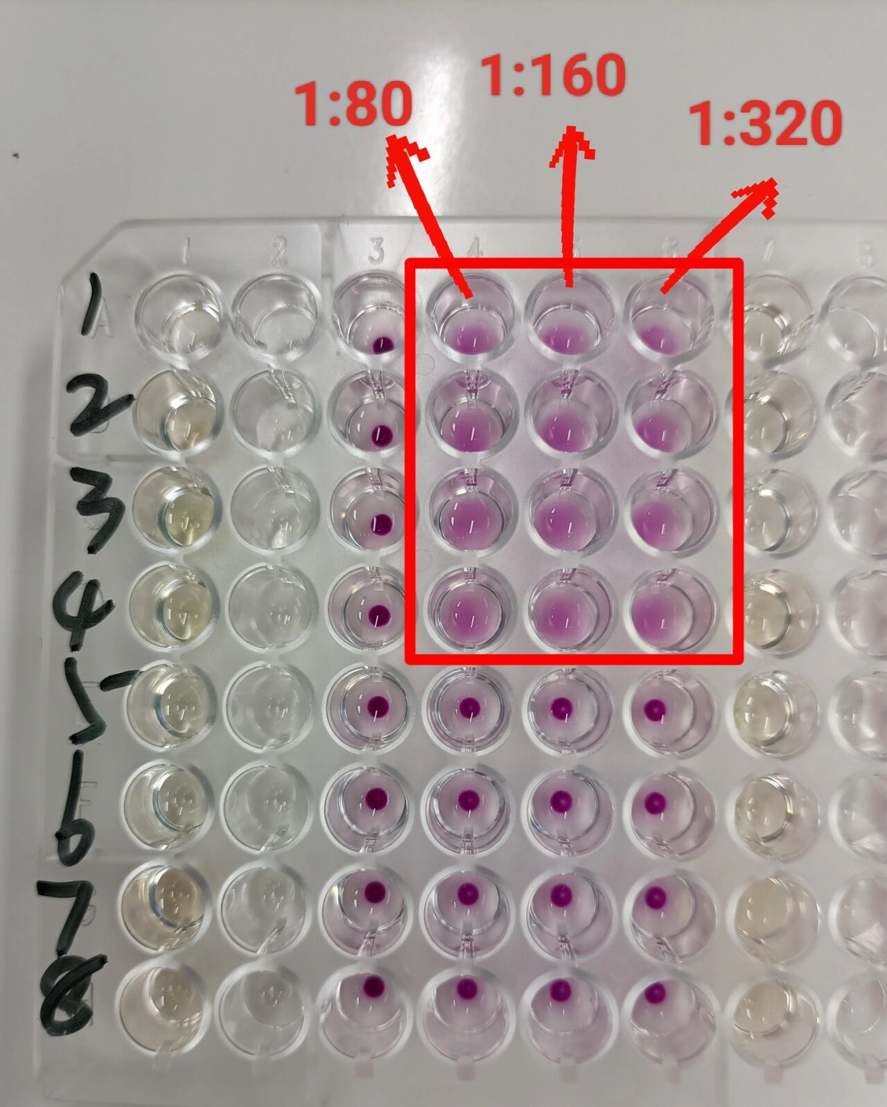 梅毒tppa试验结果该怎么看