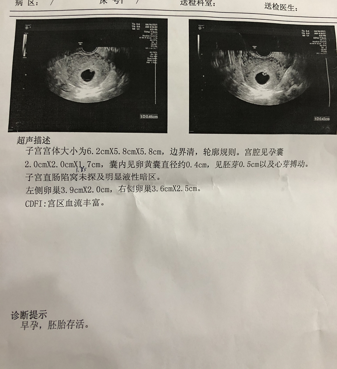 第二天就去医院抽血做b超,b超显示有卵黄囊没有胎芽胎心,因为才30多