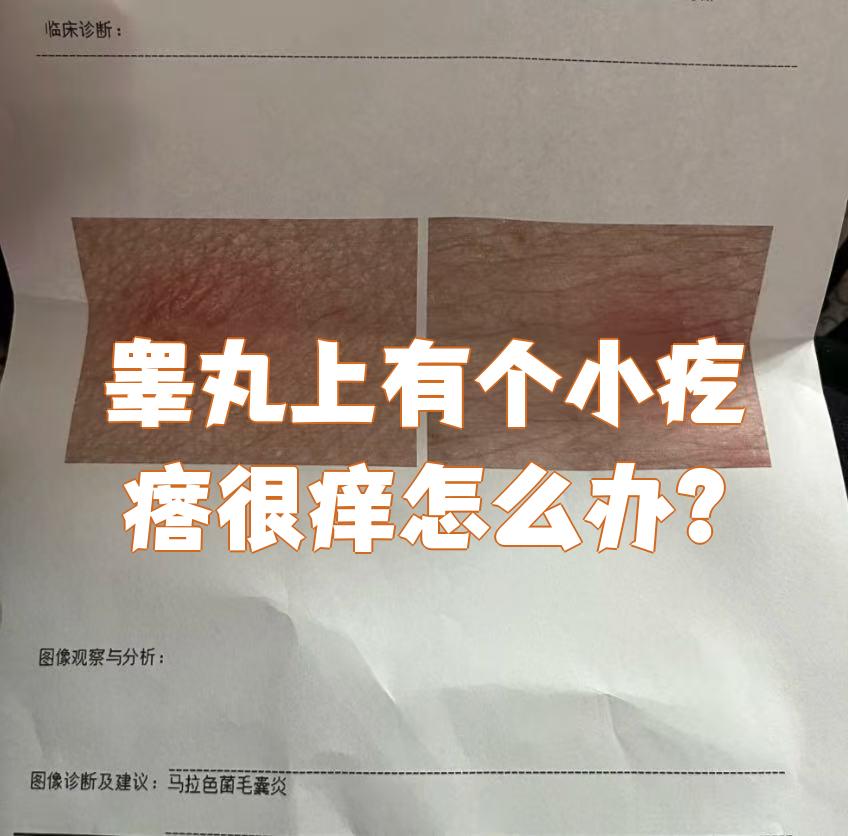 阴囊上出现小疙瘩并且很痒,可能是虫咬皮炎,毛囊炎或者尖锐湿疣
