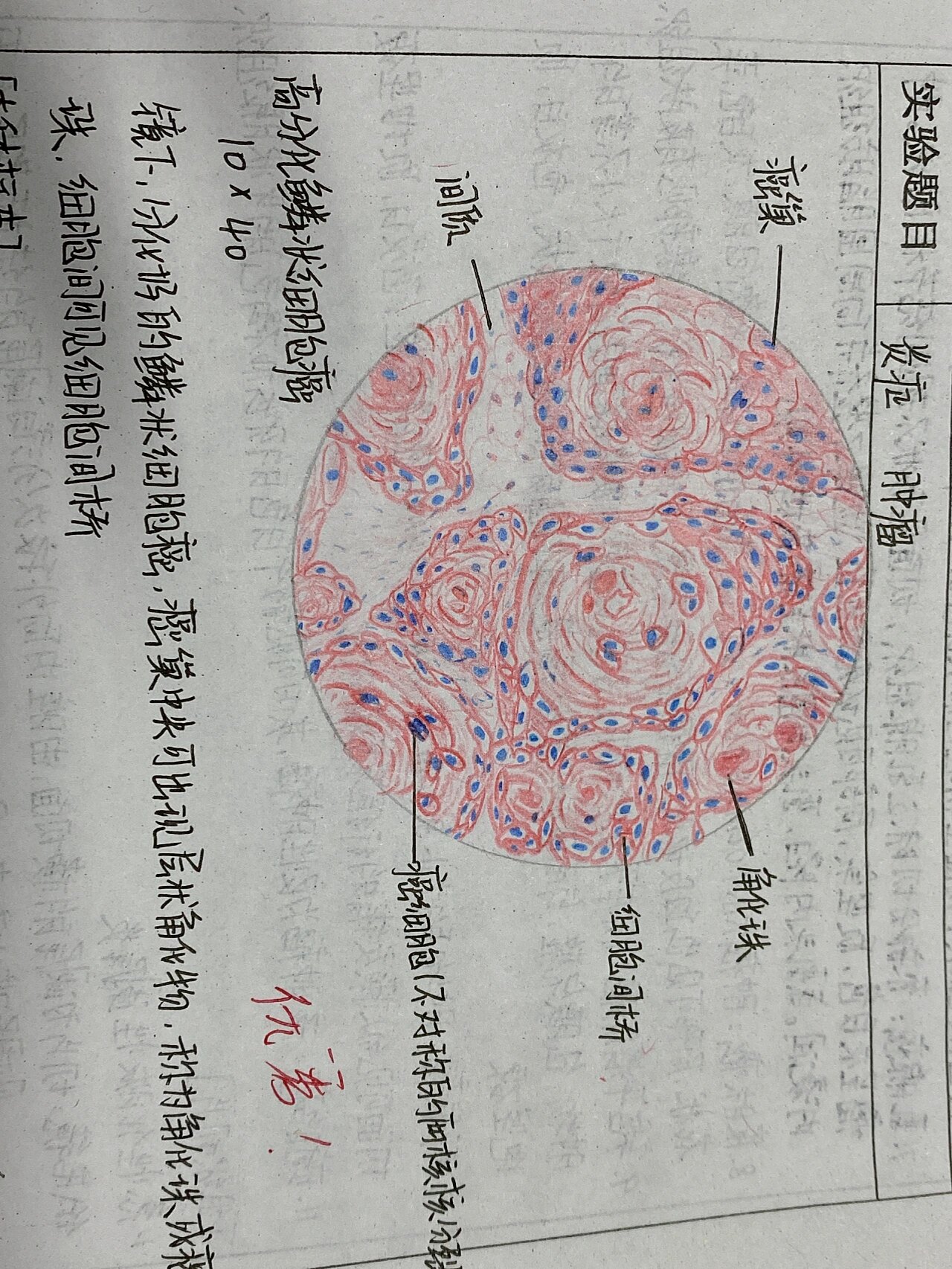高分化鳞癌红蓝铅笔绘画