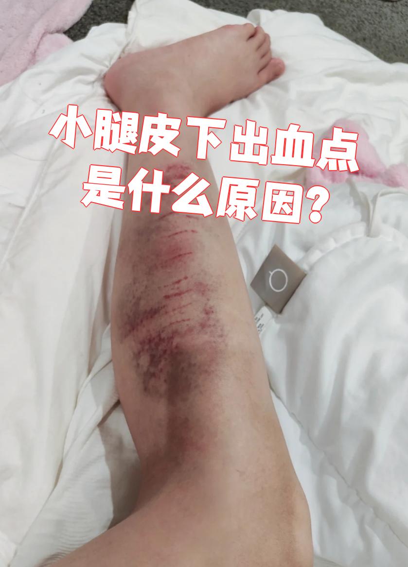 小腿皮下出血点的原因主要有三种:外伤,凝血功能障碍和过敏性紫癜