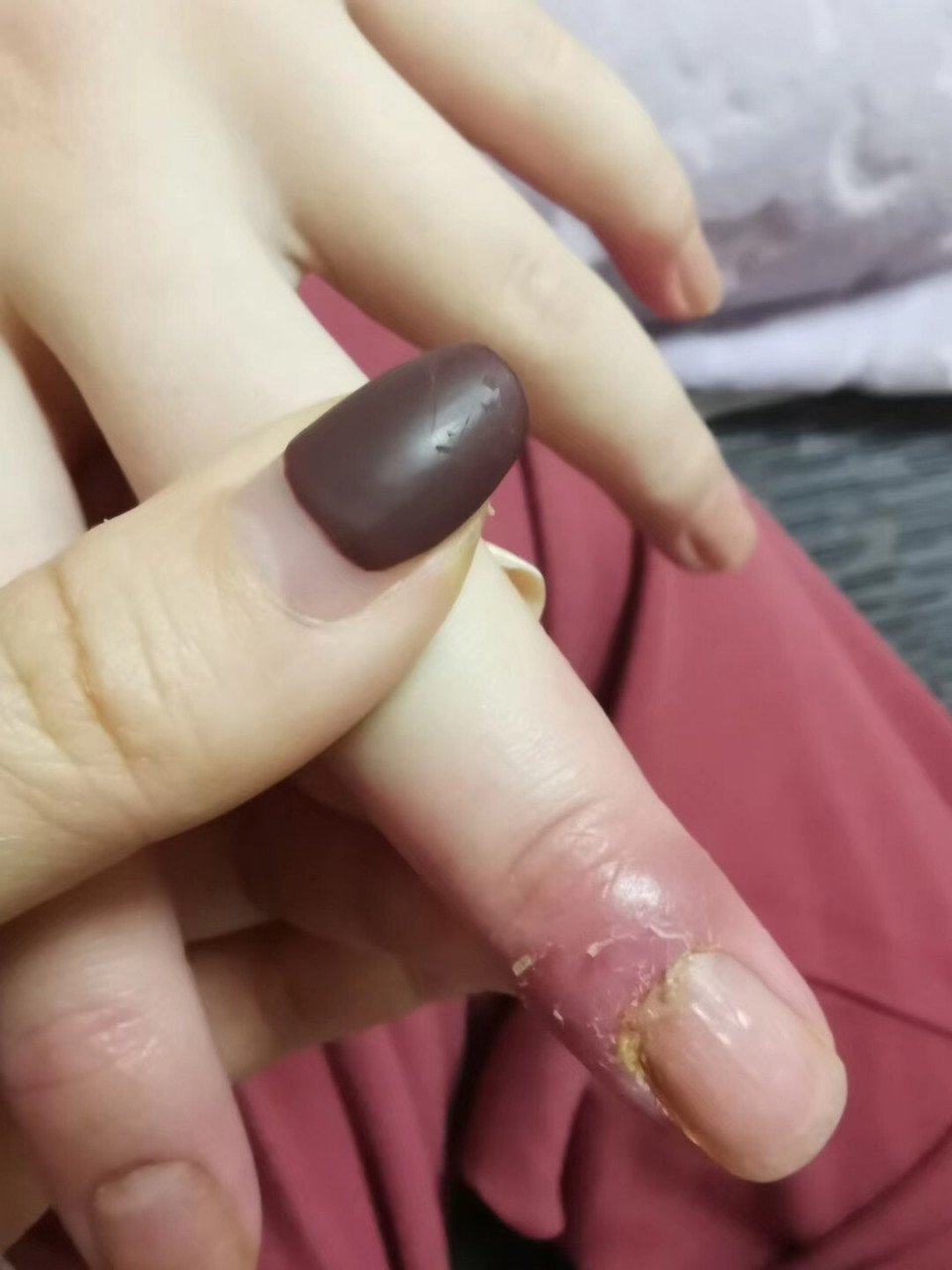 湿疹(汗疱疹 角质剥脱症)一个月的恢复情况～完美 指甲是因为之前发
