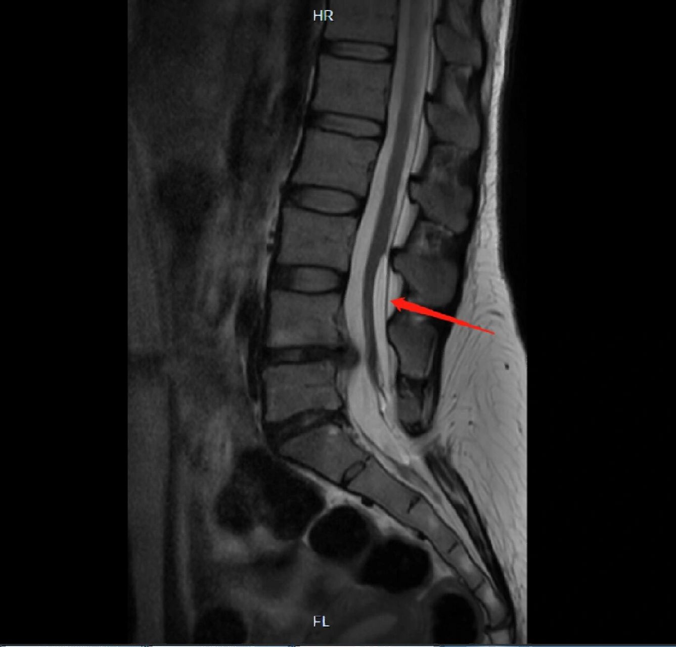 脊柱裂核磁图片