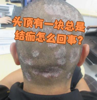 头顶反复结痂最常见的原因是头癣,脂溢性皮炎或银屑病