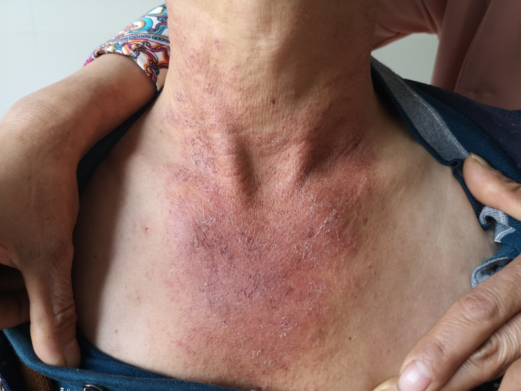 光敏性皮炎的诊疗思路 手背,腕背有红斑丘疹,而手掌和手腕曲侧皮肤