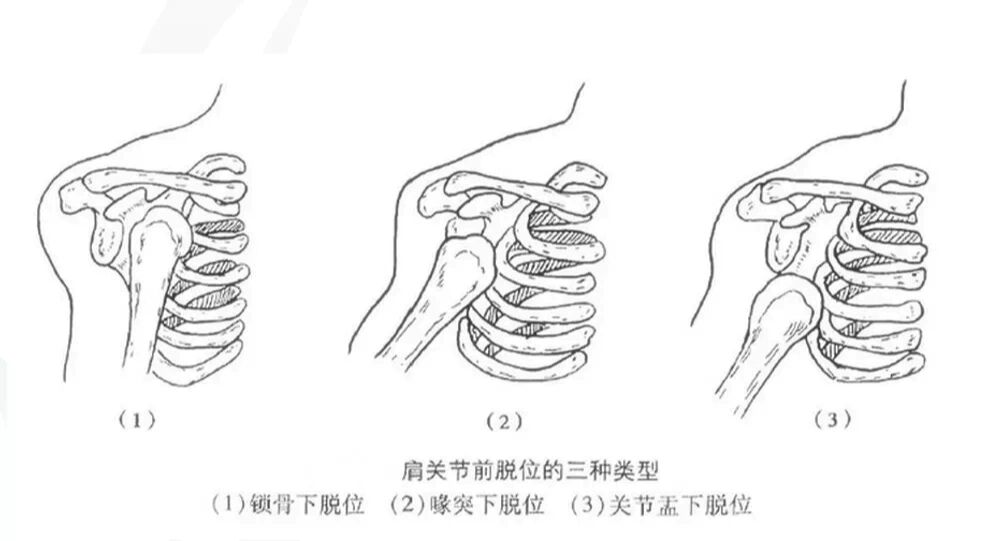 肩关节脱臼如何复位图片