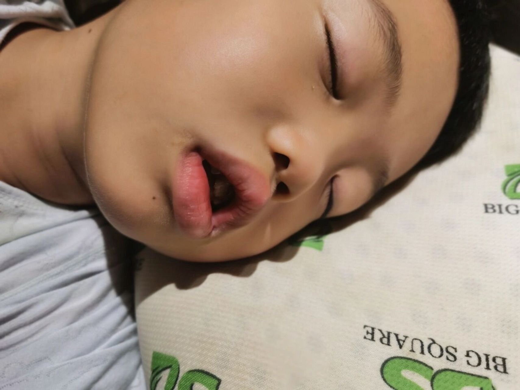 大家帮忙看下是不是腺样体面容,晚上睡觉不打鼾,也不用嘴呼吸.