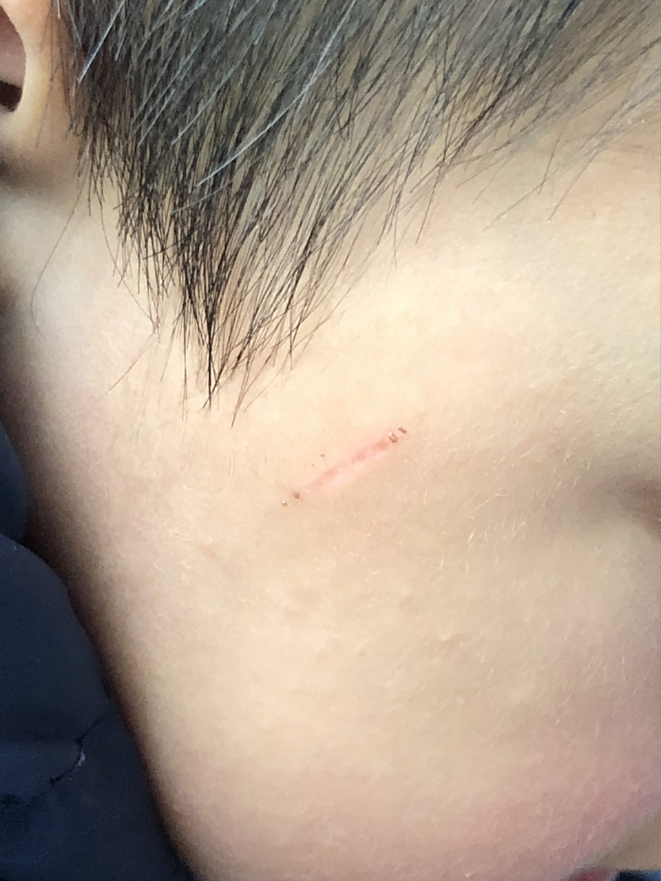 指甲抓破了脸 被邻居小孩指甲抓破了,今天一周了,结痂脱落后凹陷了