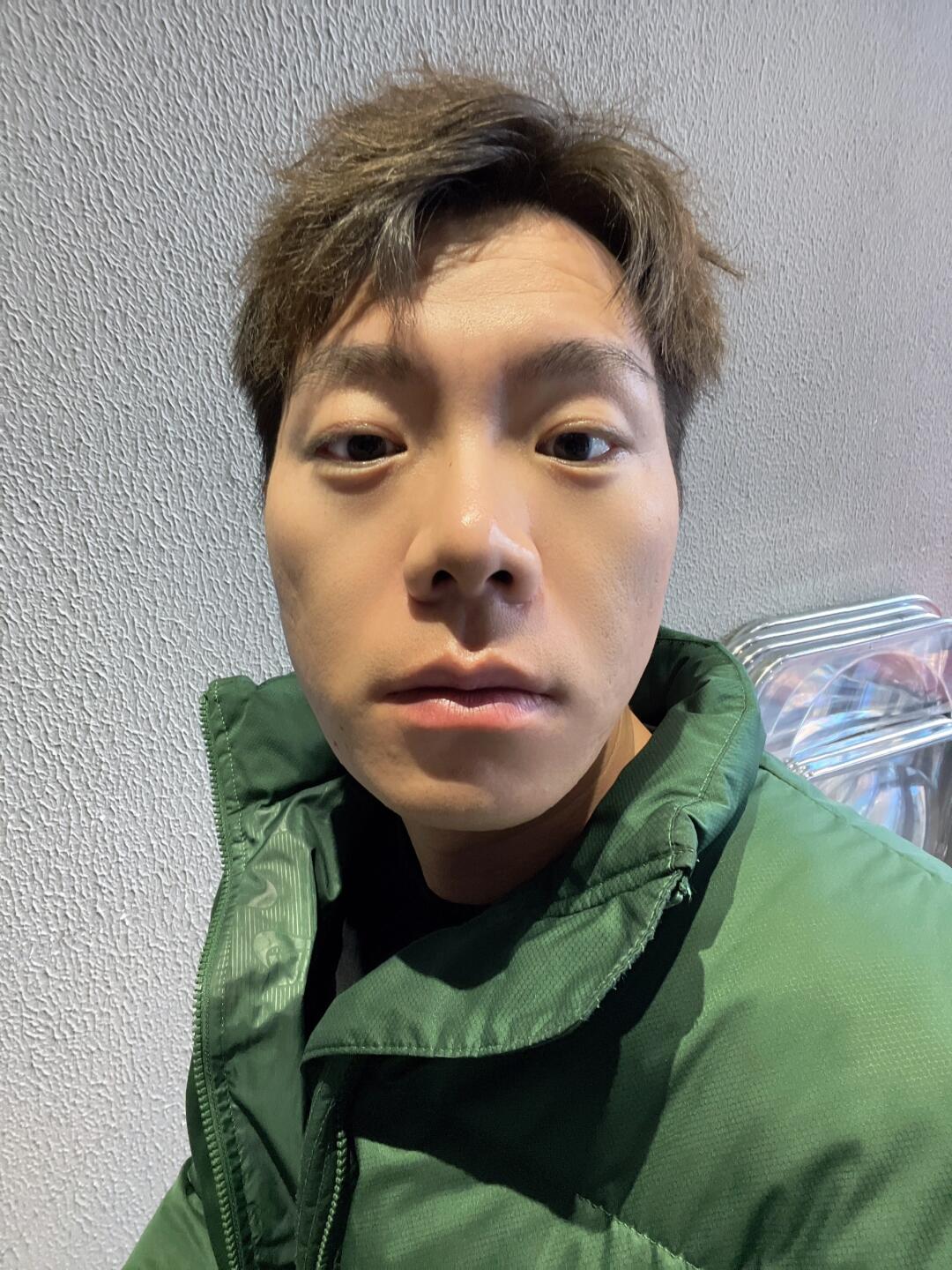 男生菱形脸的痛!在郑州正畸会变牙套脸吗