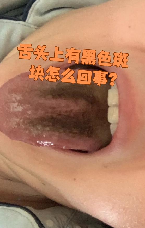 舌头变黑了什么原因引起的为什么在线