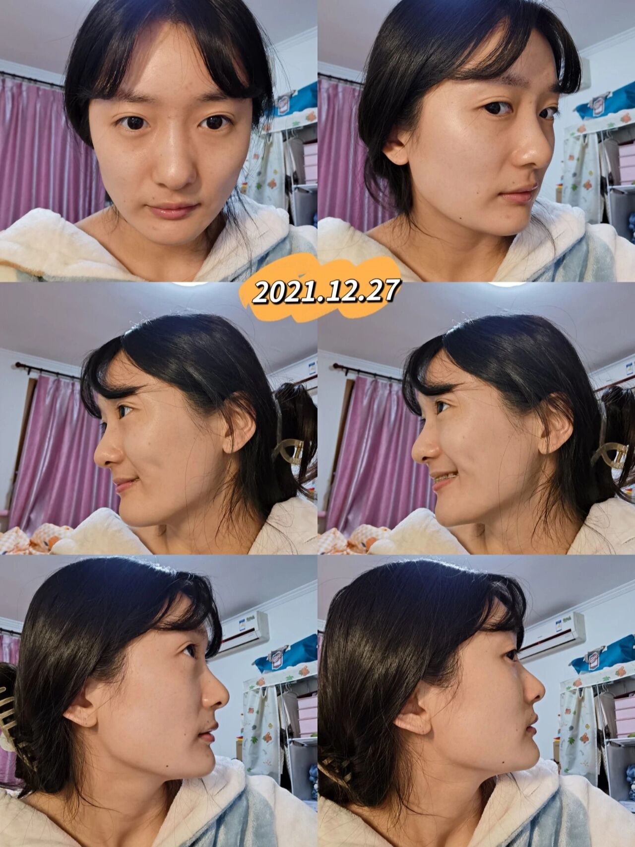 正畸瘪嘴后续(篇1)—北京面诊意见 99前言:已经一月多不发笔记了