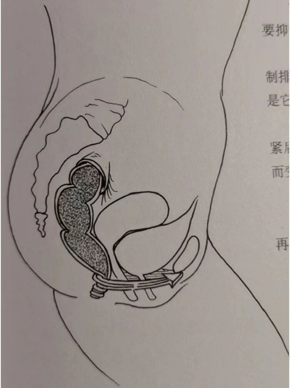 肛门大肠脱落图 脱出图片