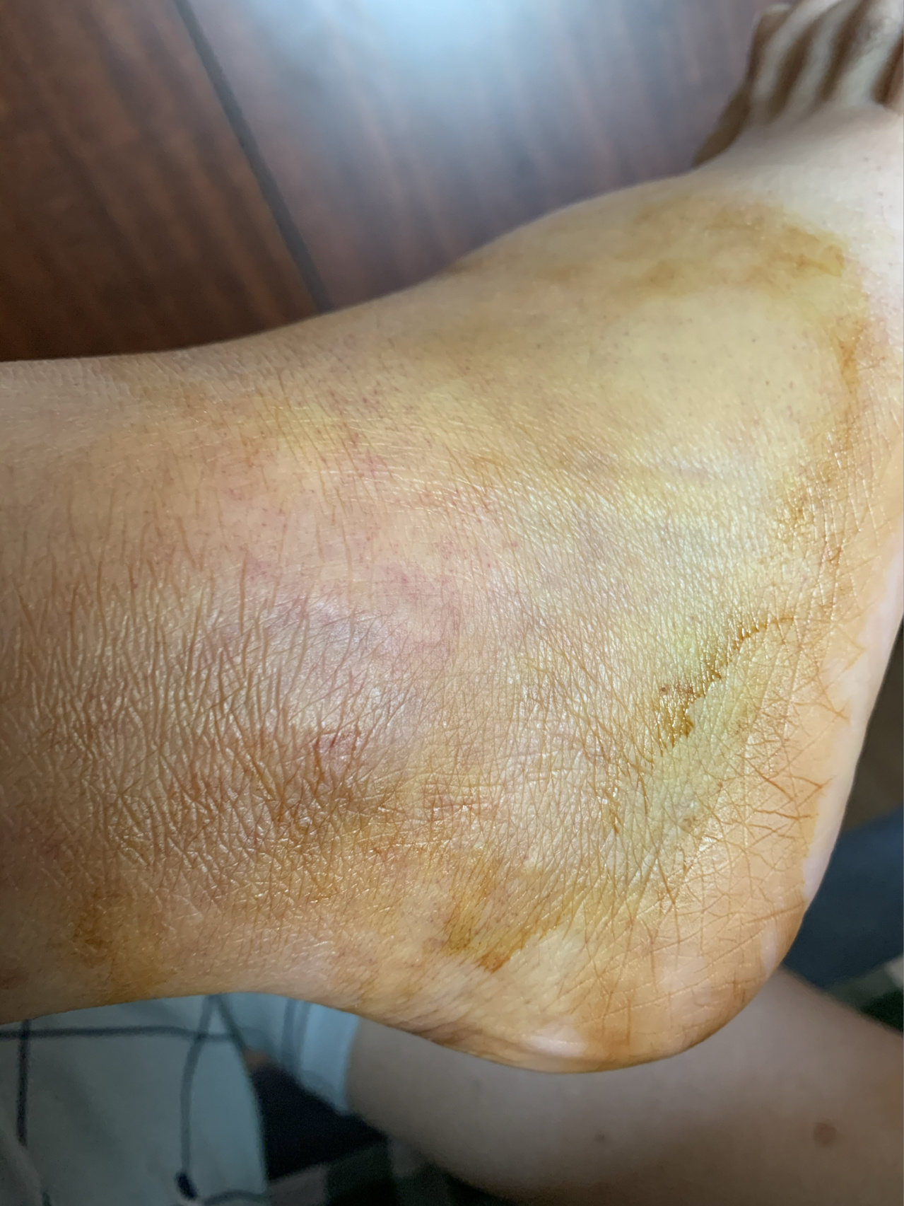 右踝骨折第40天 9月10日我居然扭骨折了,我都不敢相信我居然会骨折!