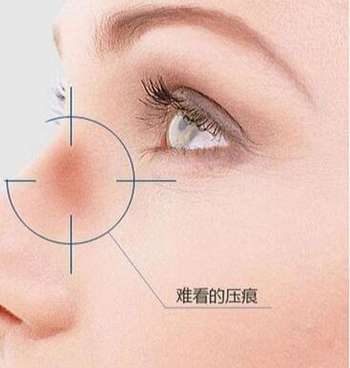 眼镜戴得鼻梁泛红,有压痕怎么办?