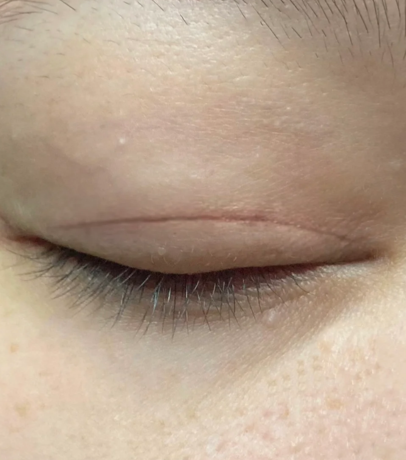 双眼皮三个月了疤痕还是很明显正常吗?