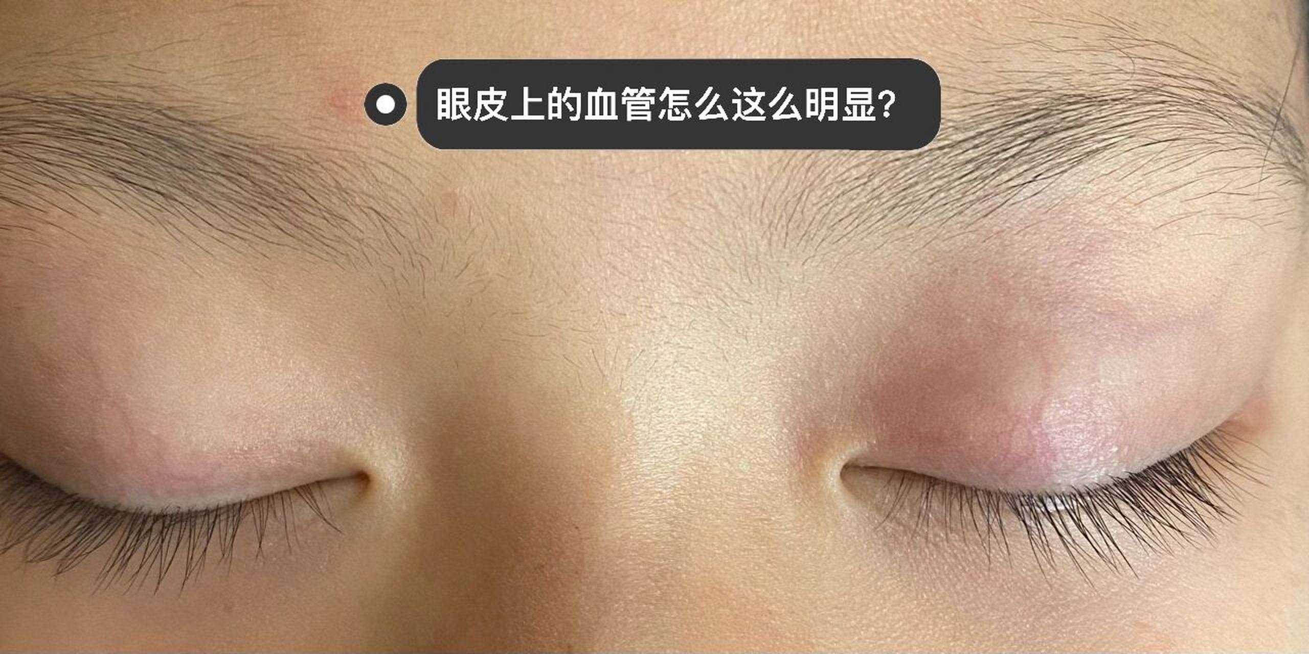小盆友眼皮上面的毛细血管怎么明显?求助这是什么原因呢?