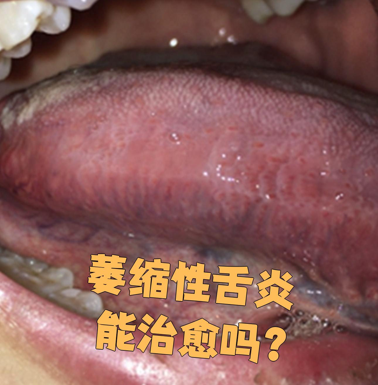 简单来说,萎缩性舌炎就是舌黏膜变薄萎缩,不仅舌乳头会消失,严重时
