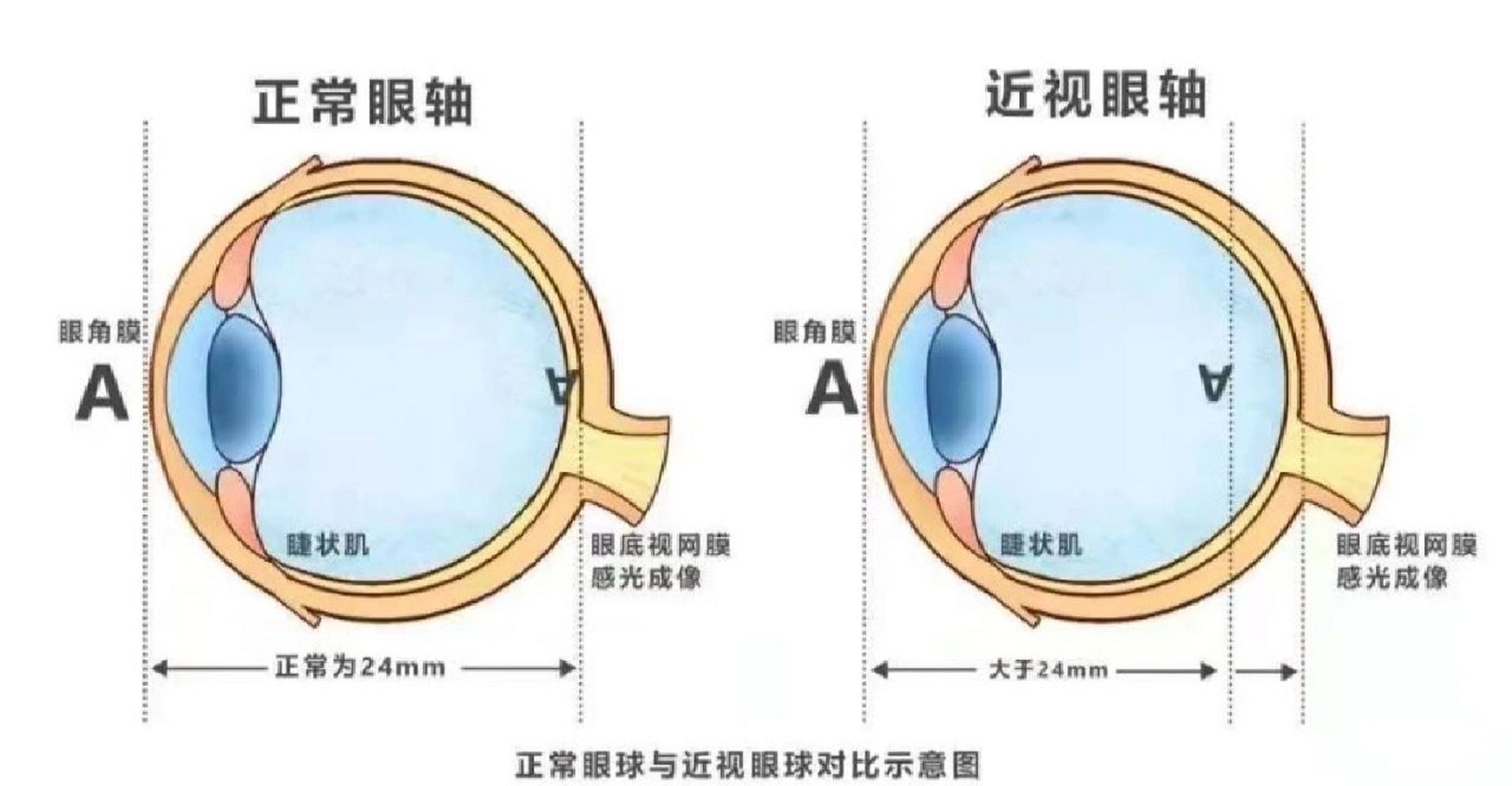 近视眼球对比图片