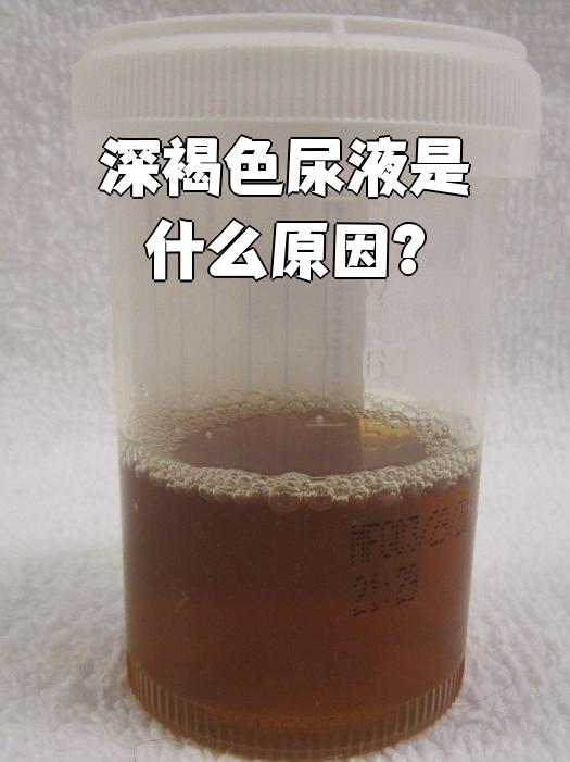 深褐色尿液可能由多种原因引起