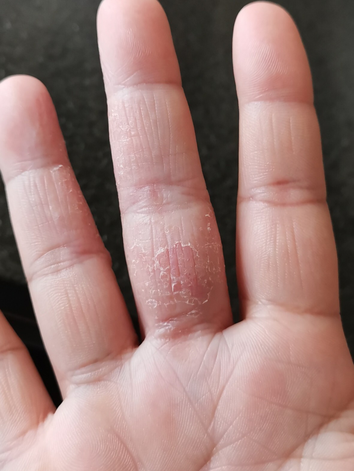 手藓我真的受不了!这一次真的告别它了!